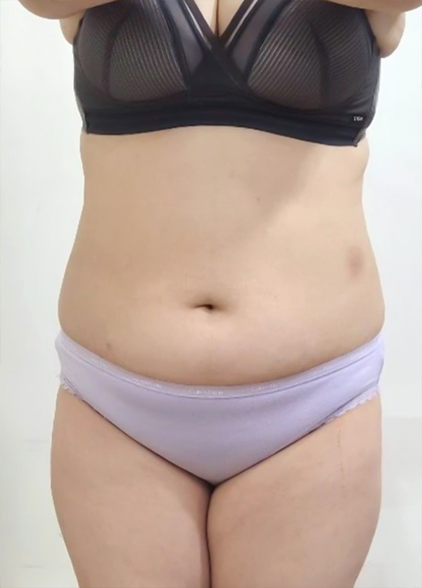 Before photo of Mungko showing excess abdominal skin before tummy tuck and 360-degree liposuction at Lesarts in Korea.