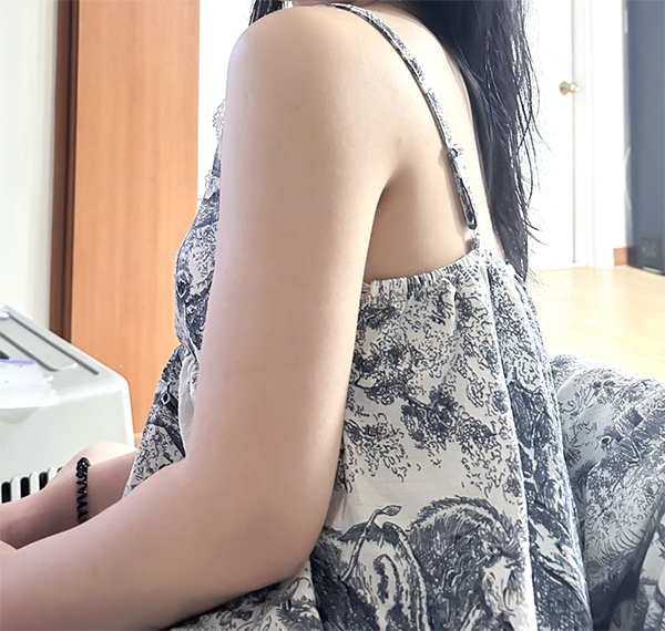 Oongkoongookkoong arm and abdominal liposuction 2 months after surgery in Korea – Lesarts Plastic Surgery