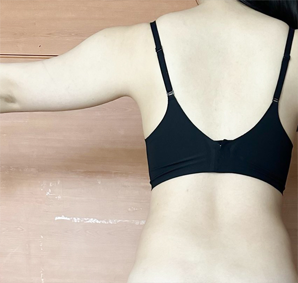 Oongkoongookkoong arm and abdominal liposuction before photo in Korea – Lesarts Plastic Surgery