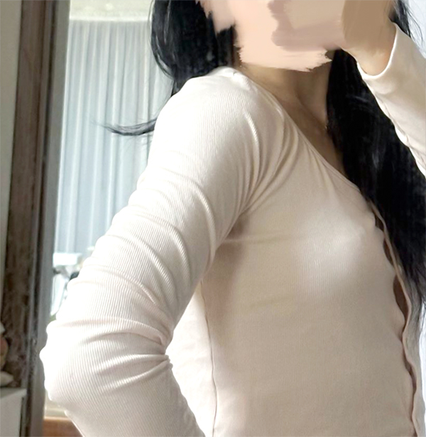 Yeou1471t arm liposuction 100 days after surgery in Korea – Lesarts Plastic Surgery