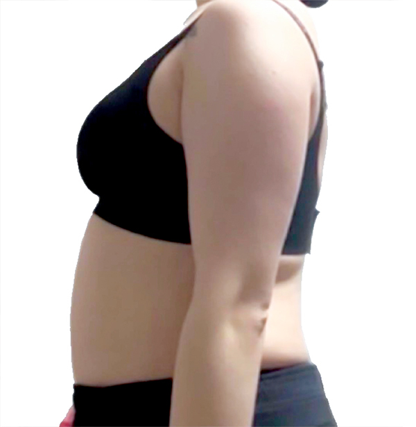 Yeou1471t upper arm fat before liposuction at best plastic surgery clinic in Seoul