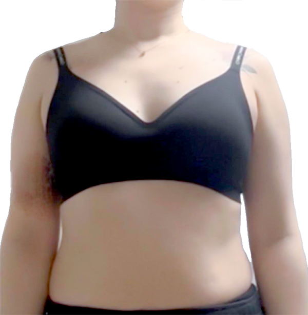 Yeou1471t arm liposuction before photo in Korea – Lesarts Plastic Surgery