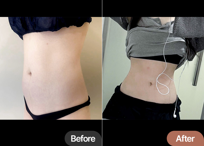 Before and after abdominal liposuction comparison of gqwls3859 at lesarts plastic surgery in Korea, showing significant waistline improvement.