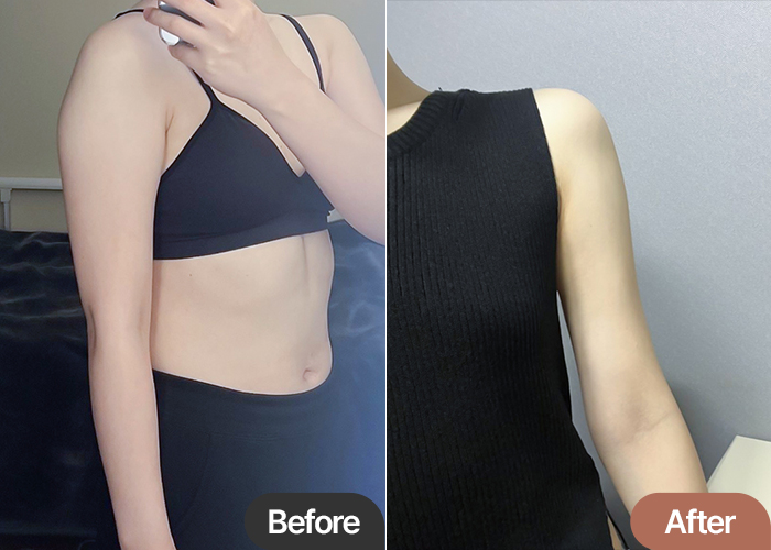 Before and after comparison of Lululalaansinna’s arm liposuction at Lesarts Plastic Surgery in Korea.