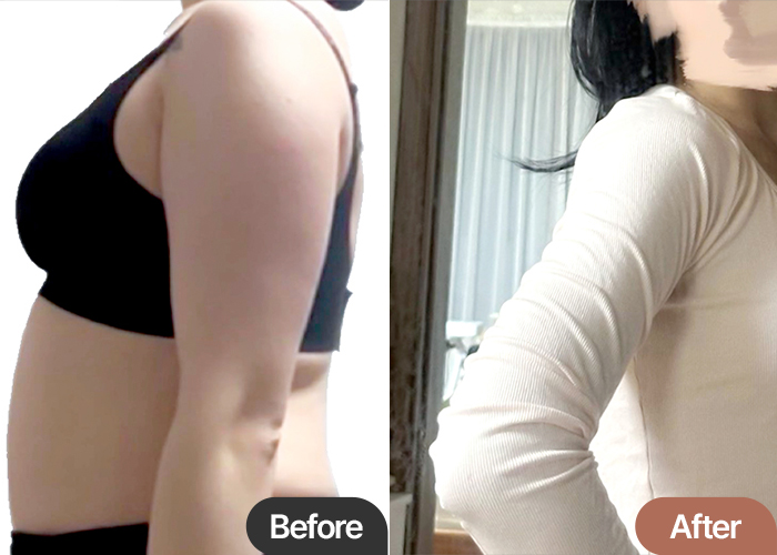 Yeou1471t arm liposuction before & after results in Korea – Best Liposuction Clinic in Seoul Lesarts