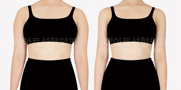 arm_liposuction_01_thumbnail_250410