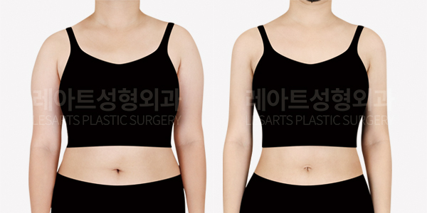 arm_liposuction_01_thumbnail_250415