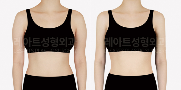 arm_liposuction_01_thumbnail_250423