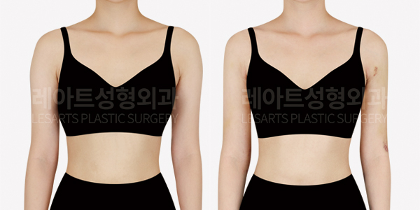 arm_liposuction_01_thumbnail_250424