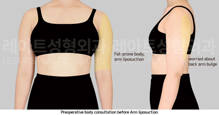 arm_liposuction_02_01_250410
