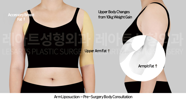 arm_liposuction_02_01_250415