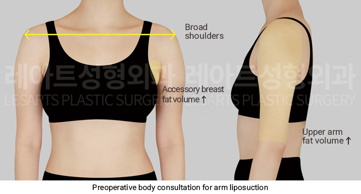 arm_liposuction_02_01_250423