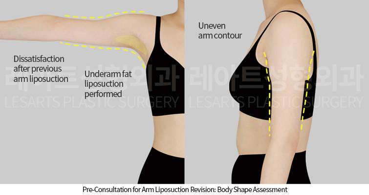 arm_liposuction_02_01_250424