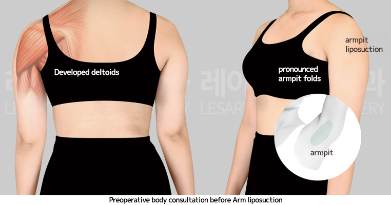arm_liposuction_02_02_250410