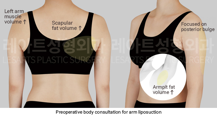 arm_liposuction_02_02_250423