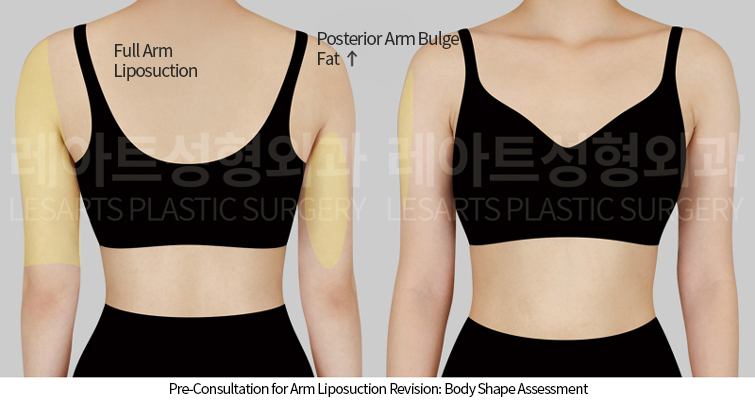 arm_liposuction_02_02_250424