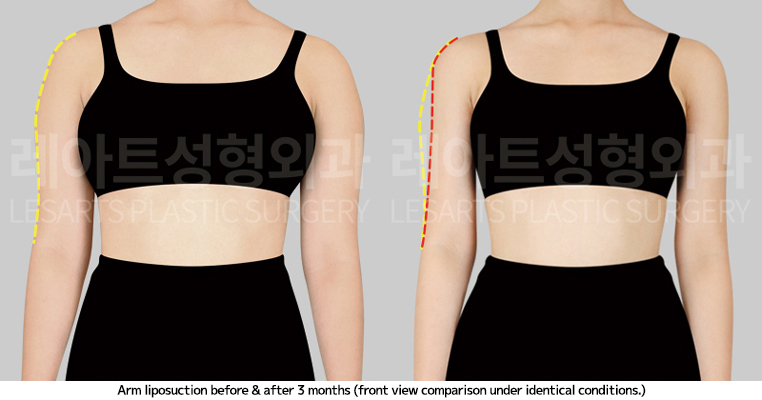 arm_liposuction_02_03_250410
