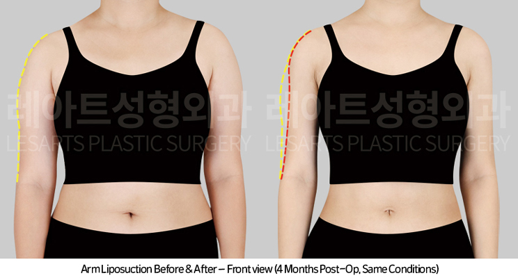arm_liposuction_02_03_250415