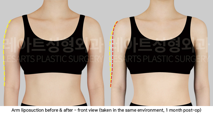 arm_liposuction_02_03_250423