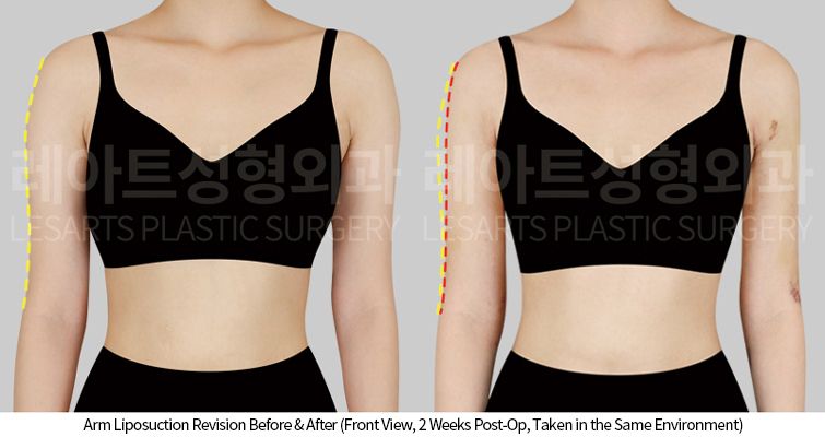 arm_liposuction_02_03_250424