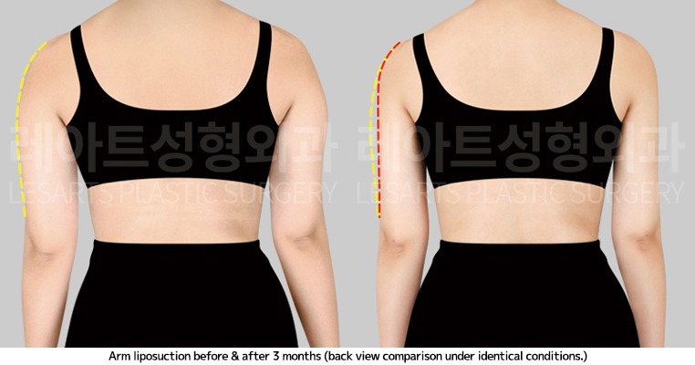 arm_liposuction_02_04_250410