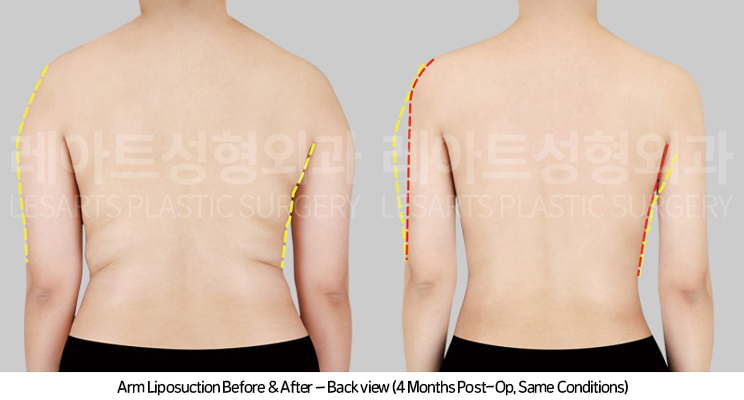 arm_liposuction_02_04_250415