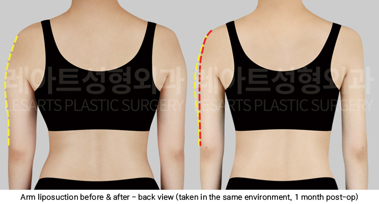 arm_liposuction_02_04_250423