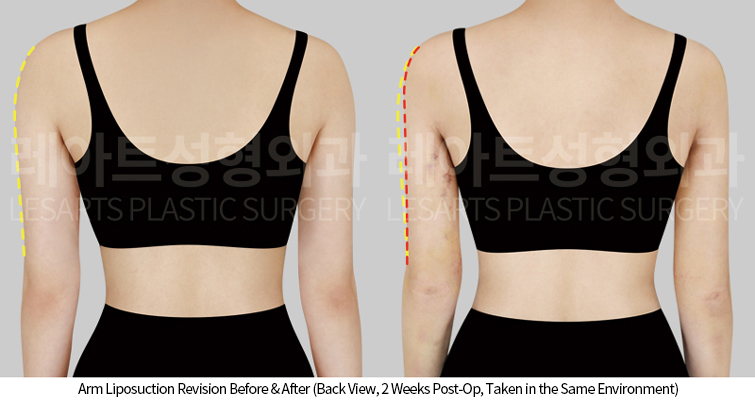 arm_liposuction_02_04_250424