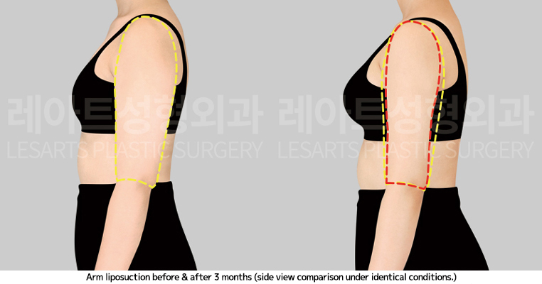 arm_liposuction_02_05_250410