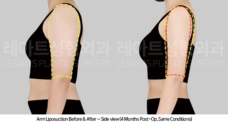 arm_liposuction_02_05_250415