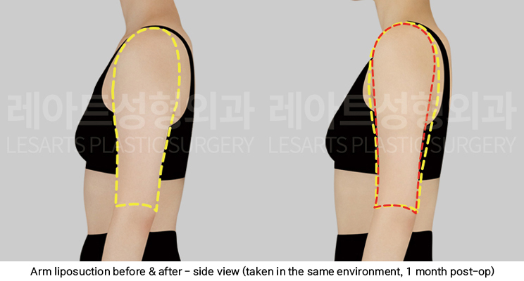 arm_liposuction_02_05_250423