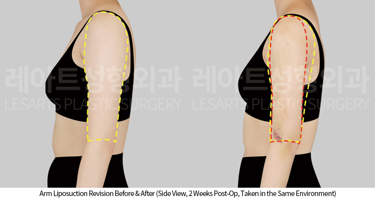 arm_liposuction_02_05_250424