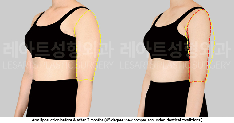 arm_liposuction_02_06_250410