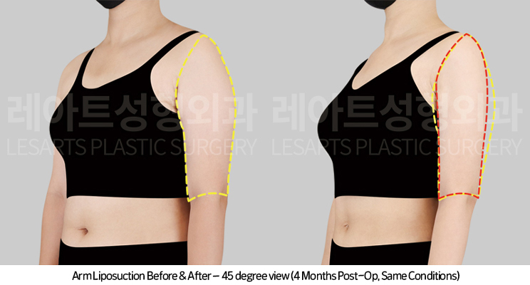 arm_liposuction_02_06_250415