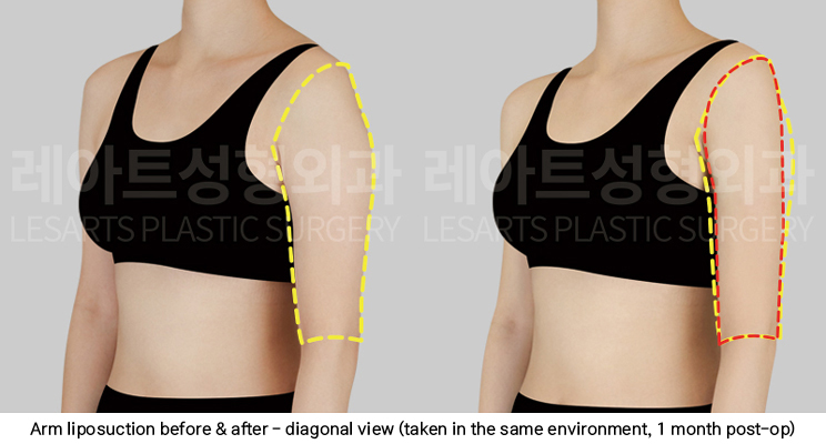 arm_liposuction_02_06_250423