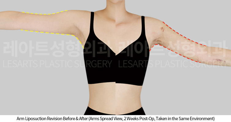arm_liposuction_02_06_250424