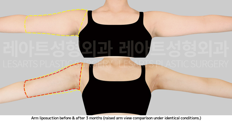 arm_liposuction_02_07_250410