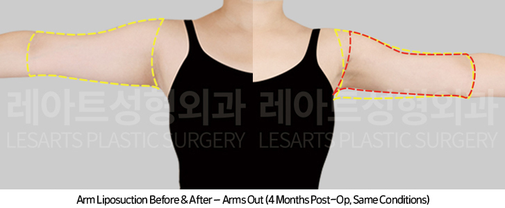 arm_liposuction_02_07_250415