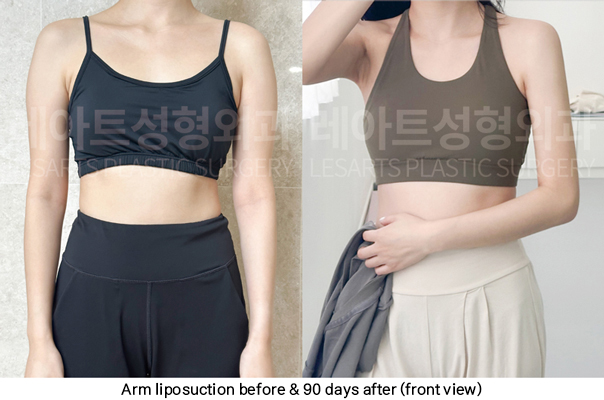 arm_liposuction_02_07_250423