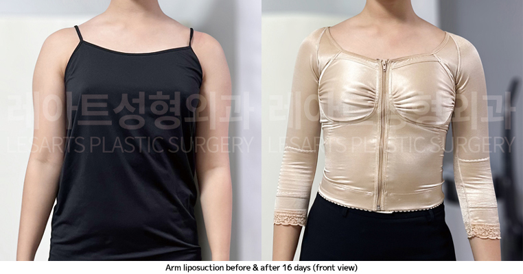 arm_liposuction_02_08_250410