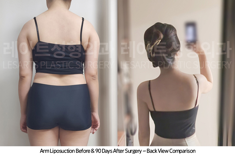 arm_liposuction_02_08_250415