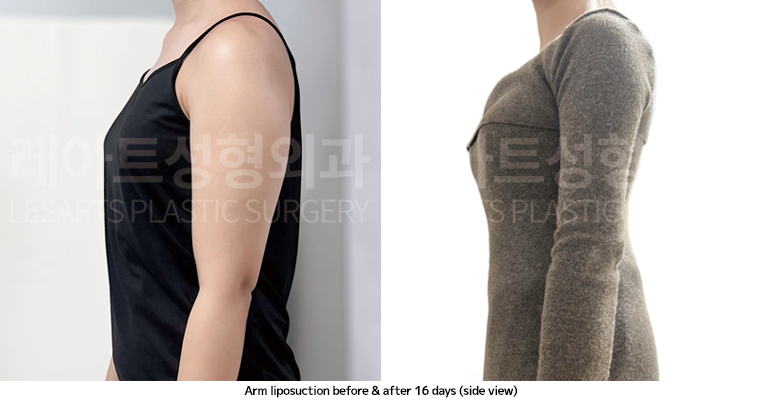 arm_liposuction_02_09_250410