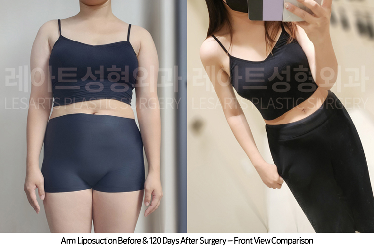 arm_liposuction_02_09_250415
