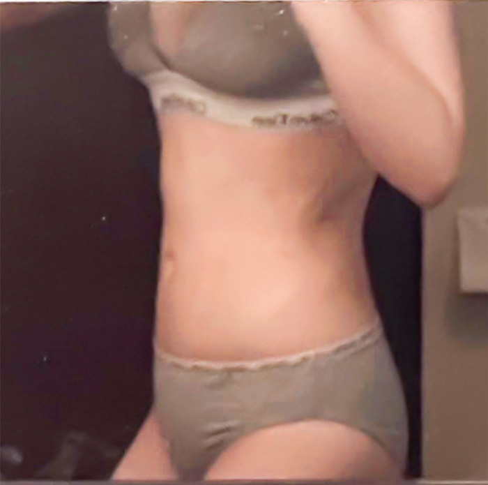 gqwls3859 after abdominal liposuction at lesarts plastic surgery in Korea, showing slim waistline and reduced belly fat.