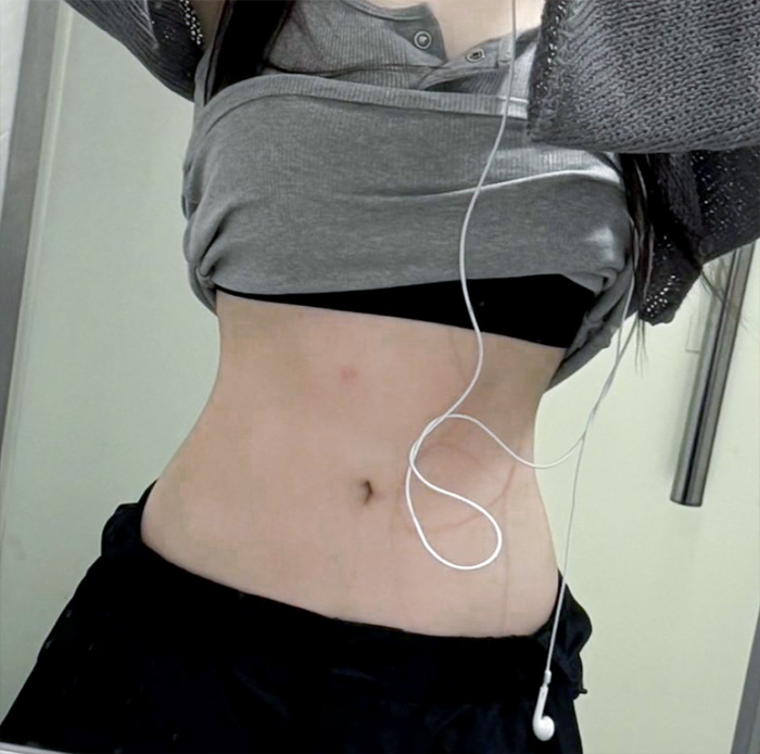 Side view of gqwls3859 after abdominal liposuction in Korea, with smooth curves and improved abdominal contour.