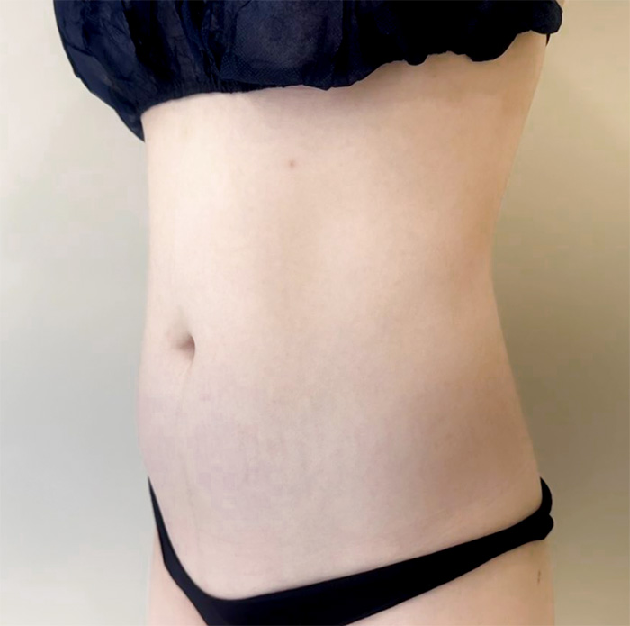 gqwls3859 before abdominal liposuction at lesarts plastic surgery in Korea, showing visible belly fat and undefined waistline.