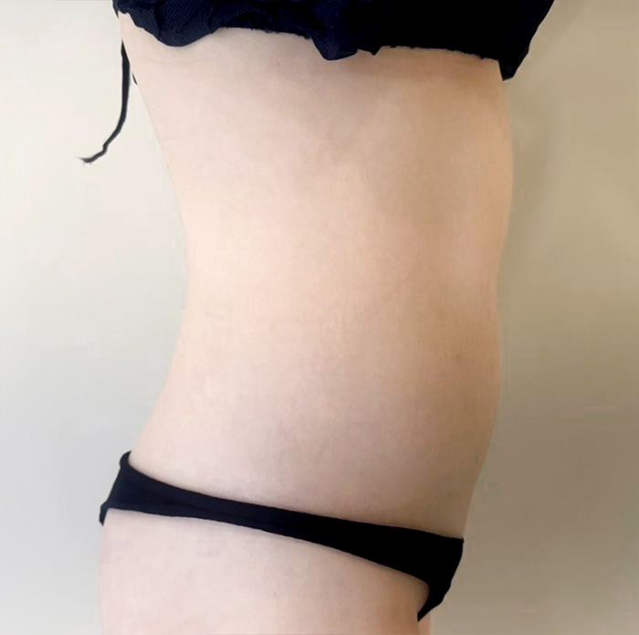 Side view of gqwls3859 before abdominal liposuction in Korea, with protruding abdomen and no curve definition.