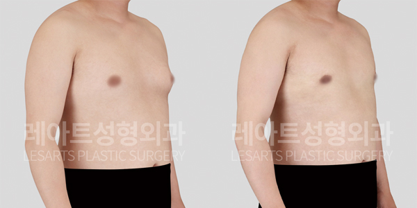 gynecomastia_01_thumbnail_250410