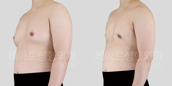 gynecomastia_01_thumbnail_250416