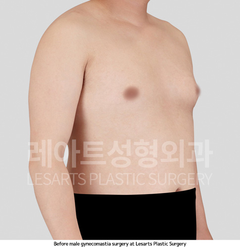 gynecomastia_02_01_250410